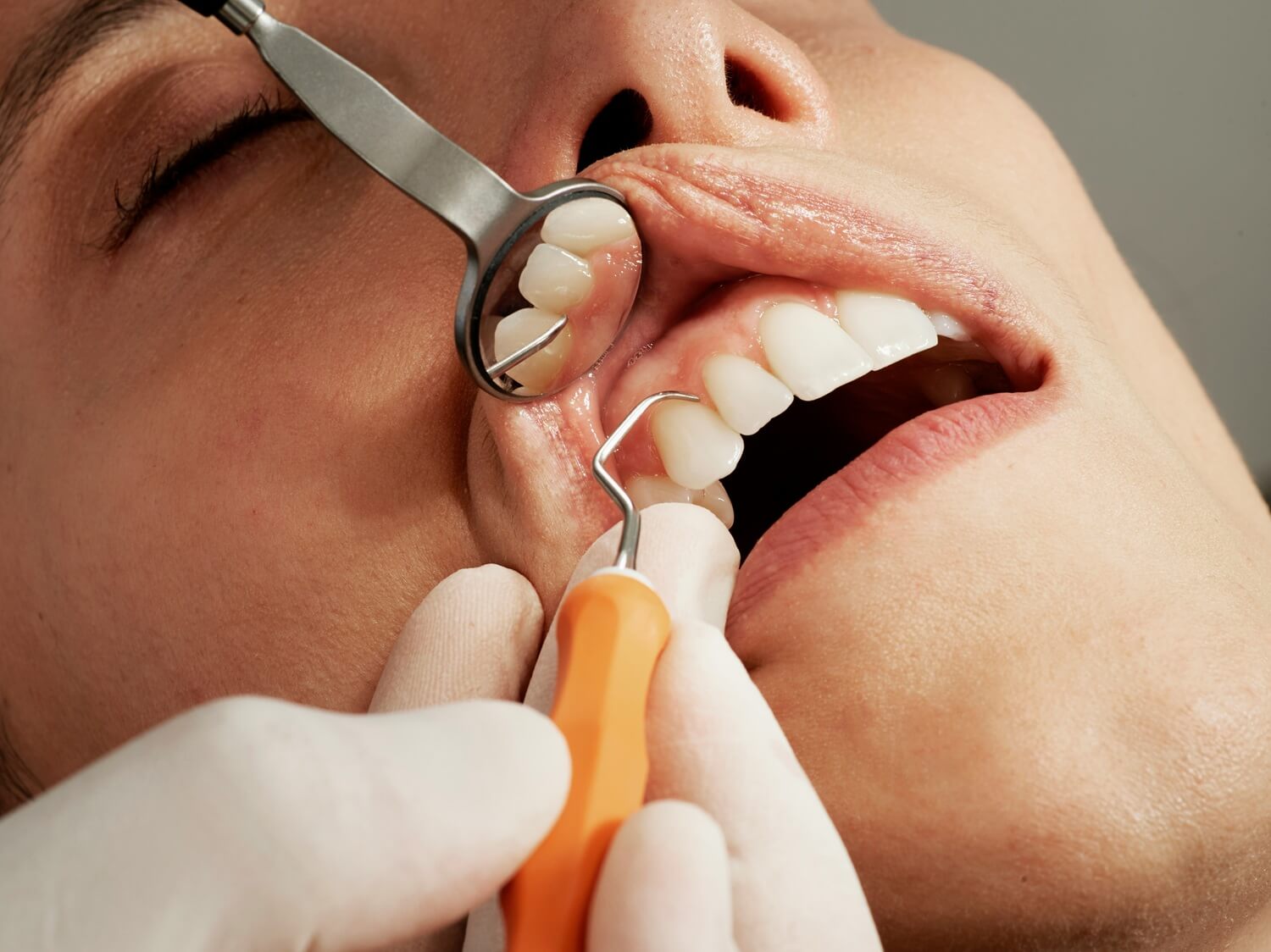 dental veneers